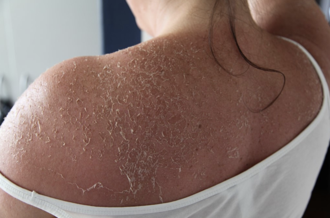 A red light therapy panel can help reduce sunburn damage and support faster healing to prevent skin peeling.